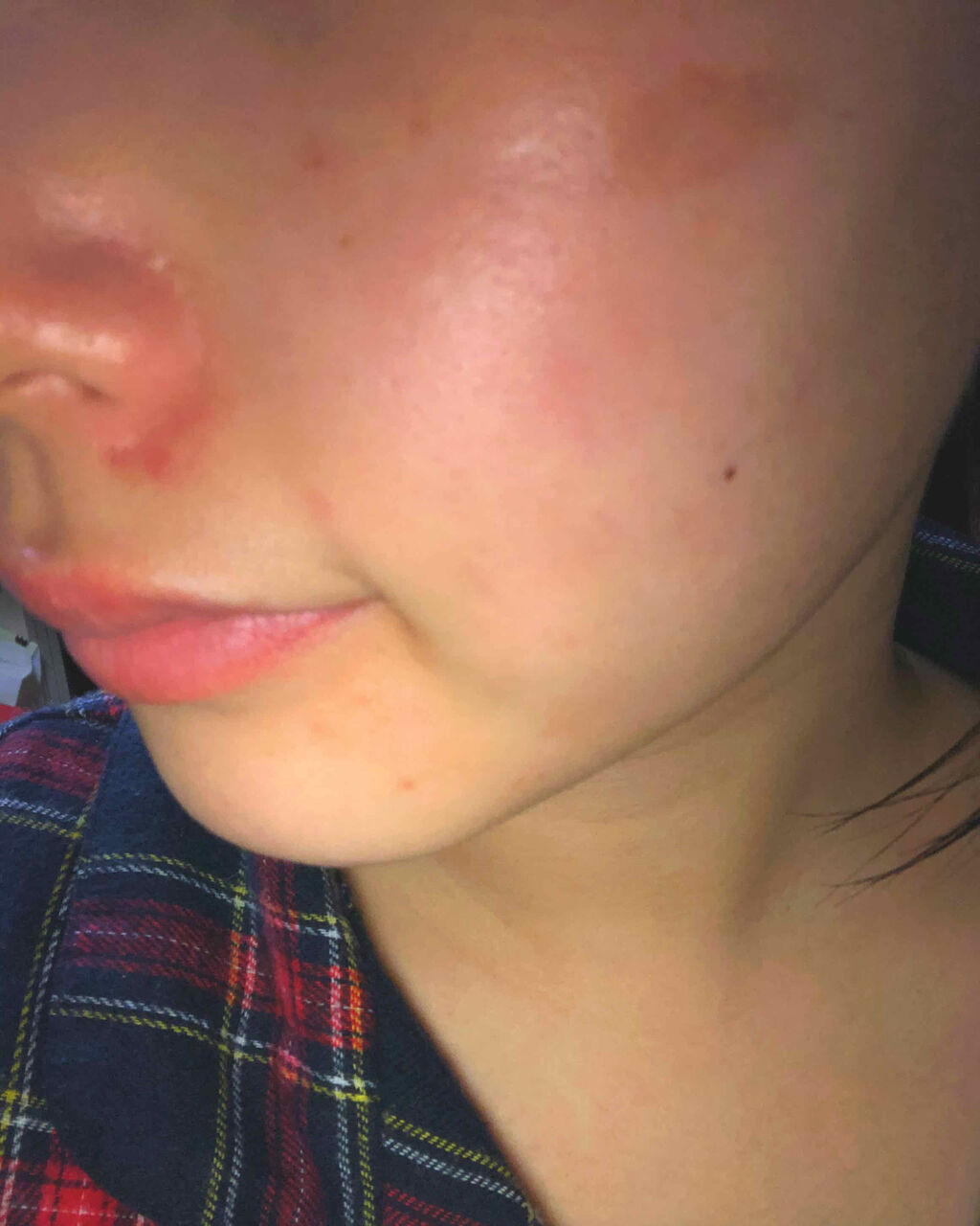 バイオイル/バイオイル/フェイスオイルを使ったクチコミ（3枚目）