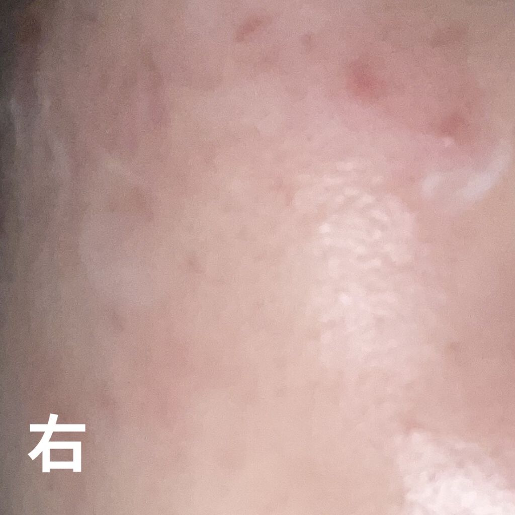 ディフェリンゲル0.1%/ガルデルマ/その他スキンケアを使ったクチコミ（2枚目）