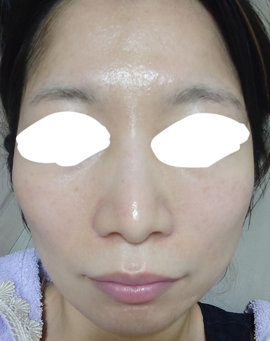 CHA on LIPS 「2枚目からは加工なしのすっぴん写真なので閲覧注意です。1週間経..」(2枚目)