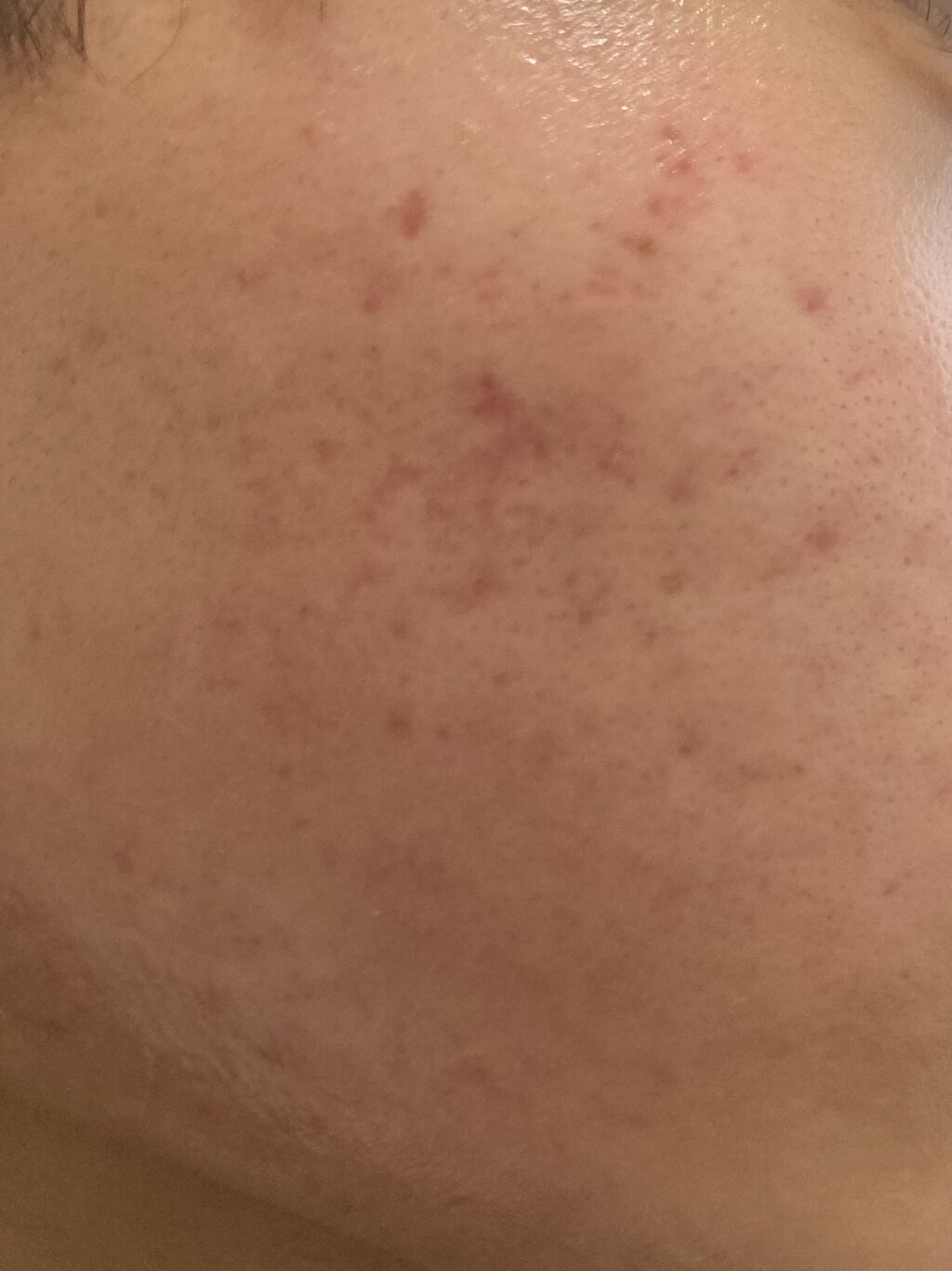 エピデュオゲル/マルホ株式会社/その他を使ったクチコミ（2枚目）