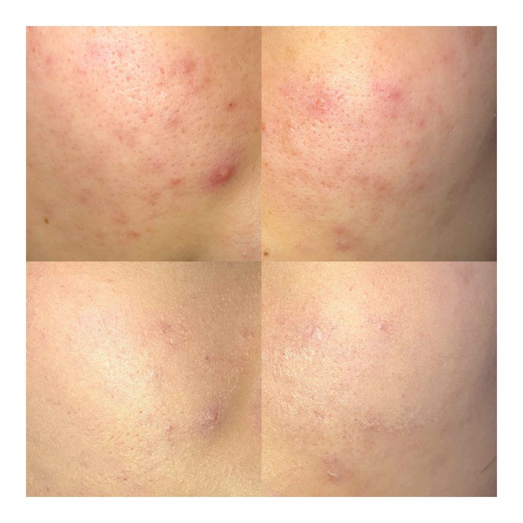 SP クッション ウルトラカバークッション BB/MAYBELLINE NEW YORK/クッションファンデーションを使ったクチコミ(2枚目)