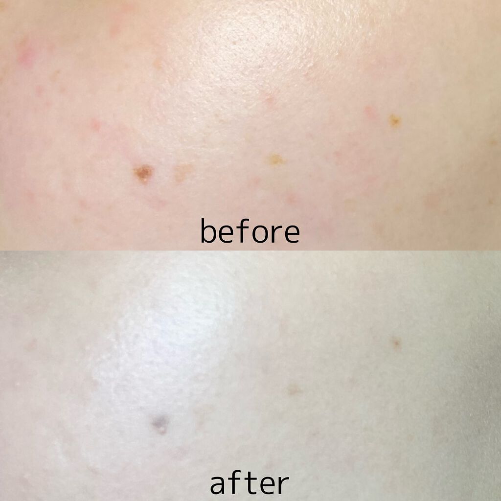 ããŒã»ãã ããŠã㌠ã¯ãã·ã§ã³/innisfree/ã¯ãã·ã§ã³ãã¡ã³ããŒã·ã§ã³ã䜿ã£ãã¯ãã³ãïŒ4æç®ïŒ