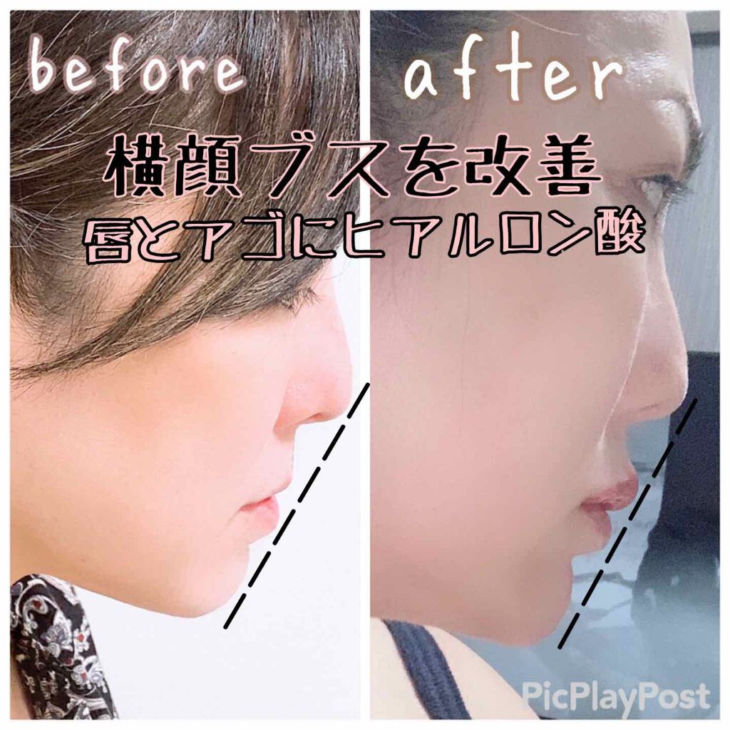 ヒアルロン酸/ビューティーワールド/その他を使ったクチコミ（2枚目）