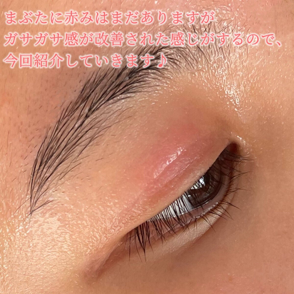 ピアソンHPクリーム(医薬品)/ピアソンHP/その他を使ったクチコミ(2枚目)