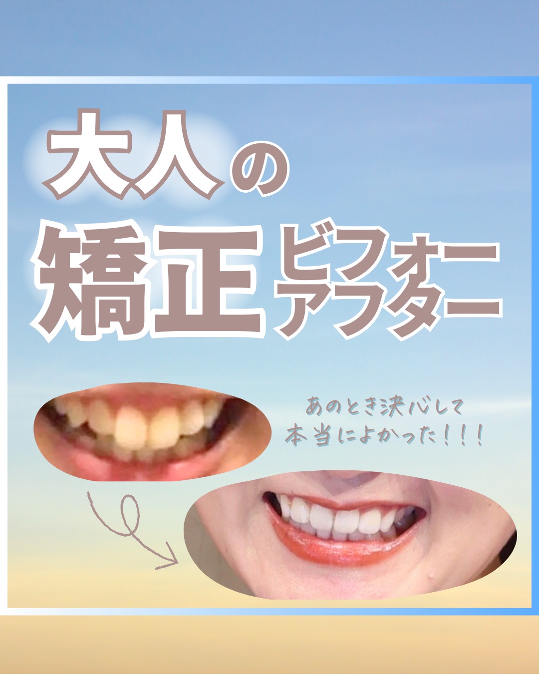 アパガードプレミオ/アパガード/歯磨き粉を使ったクチコミ（1枚目）