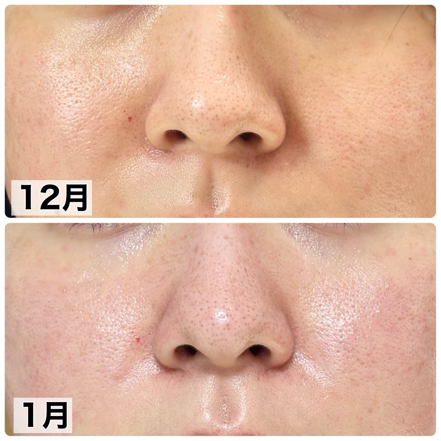 タカミスキンピール/タカミ/ブースター・導入液を使ったクチコミ(2枚目)