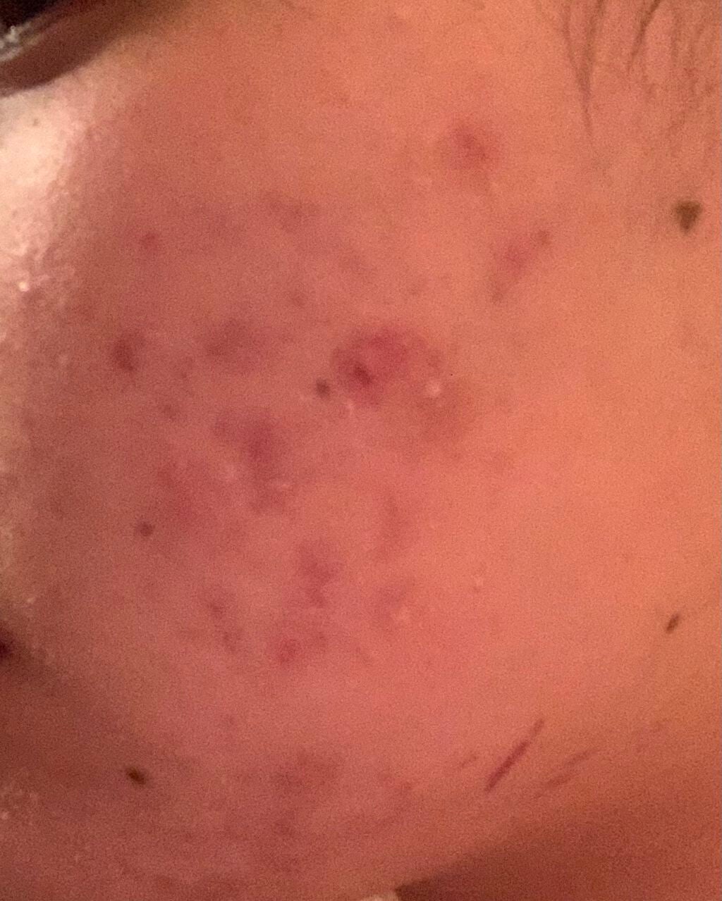 とろり on LIPS 「はい!ニキビ!!!!(写真撮影風)いや酷くなってますやん.....」(1枚目)