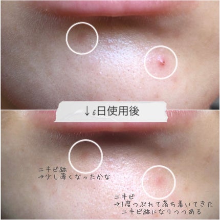 大人のニキビ対策 薬用クリアスポッツ美容液 /肌美精/美容液を使ったクチコミ(3枚目)