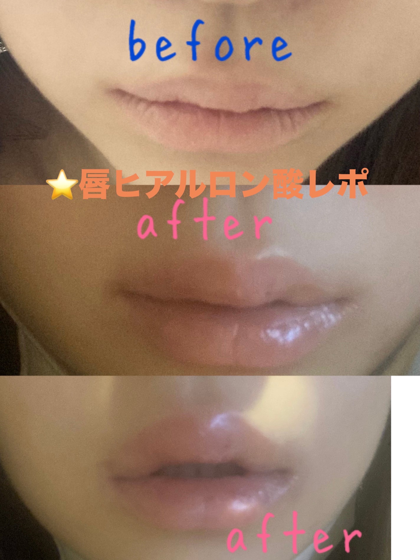 ゆめぽん🍡フォロバ100 on LIPS 「⭐️唇ヒアルロン酸レポ本日唇ヒアルをしました❣️笑気麻酔(オプ..」(1枚目)