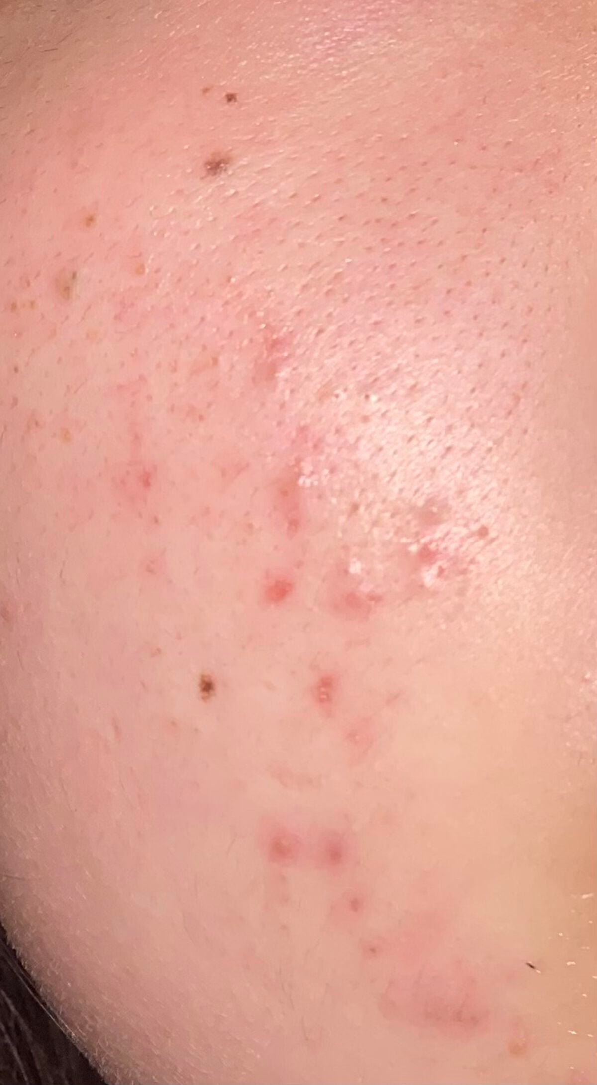 パーフェクトホイップ アクネケア/SENKA(専科)/洗顔フォームを使ったクチコミ(1枚目)