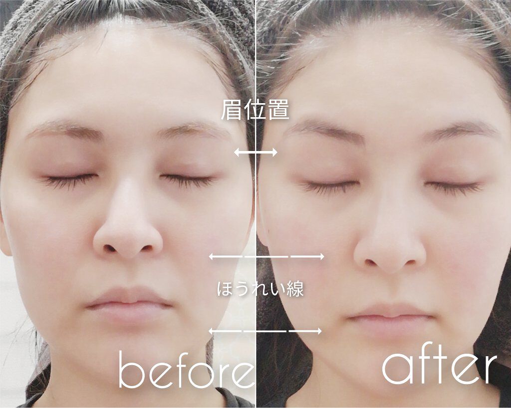 FacePump Premium(フェイスポンプ プレミアム)/the beautools/美顔器・マッサージを使ったクチコミ(4枚目)
