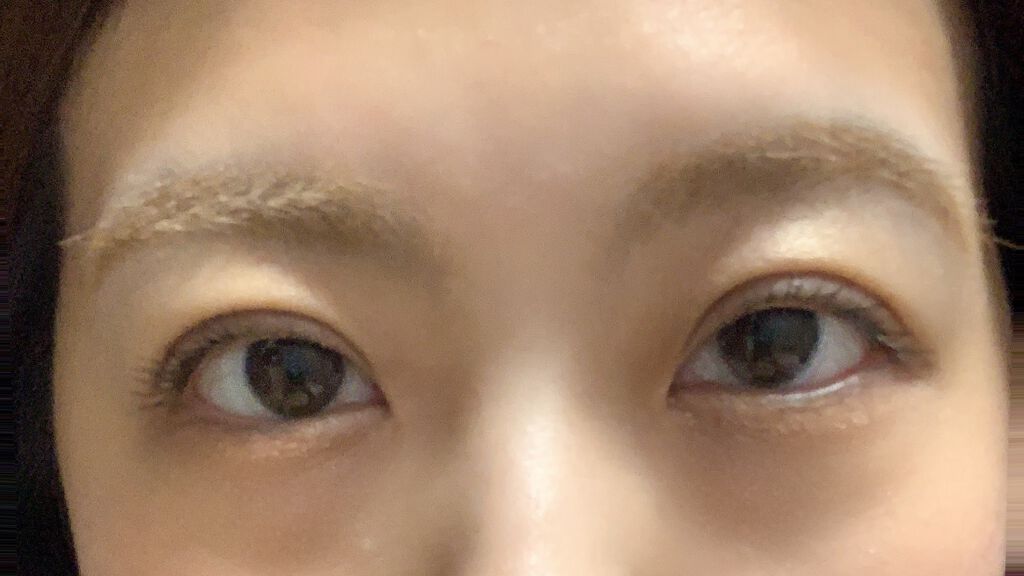 二重整形/その他を使ったクチコミ（1枚目）