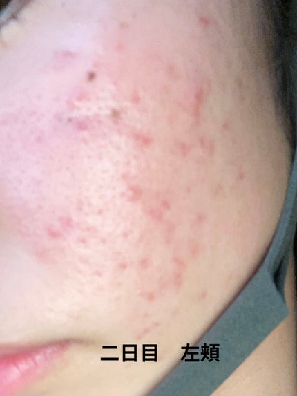 じぇーけー on LIPS 「私は中学2年生の始め頃からニキビが増え始めて、気になって潰した..」(5枚目)