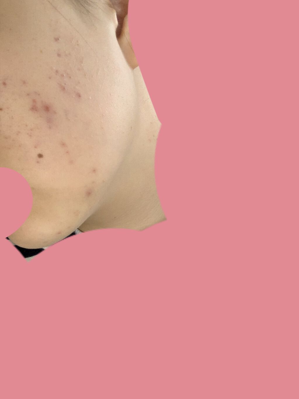 ペアアクネクリームW(医薬品)/ペア/その他を使ったクチコミ（2枚目）