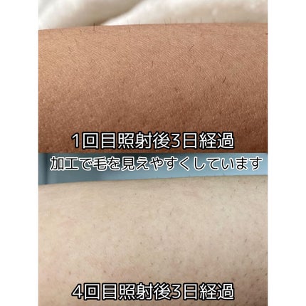 光脱毛器 VIO/Sarlisi/家庭用脱毛器を使ったクチコミ(1枚目)