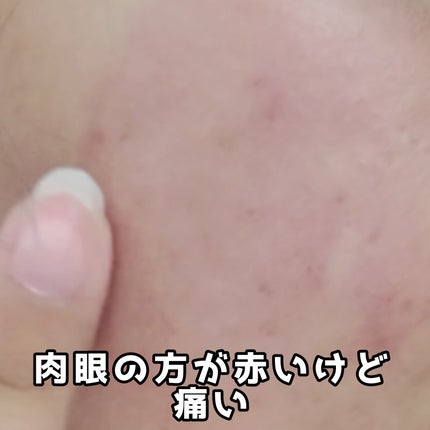 プルパ ポイントパック/セリア/シートマスク・パックを使ったクチコミ(4枚目)