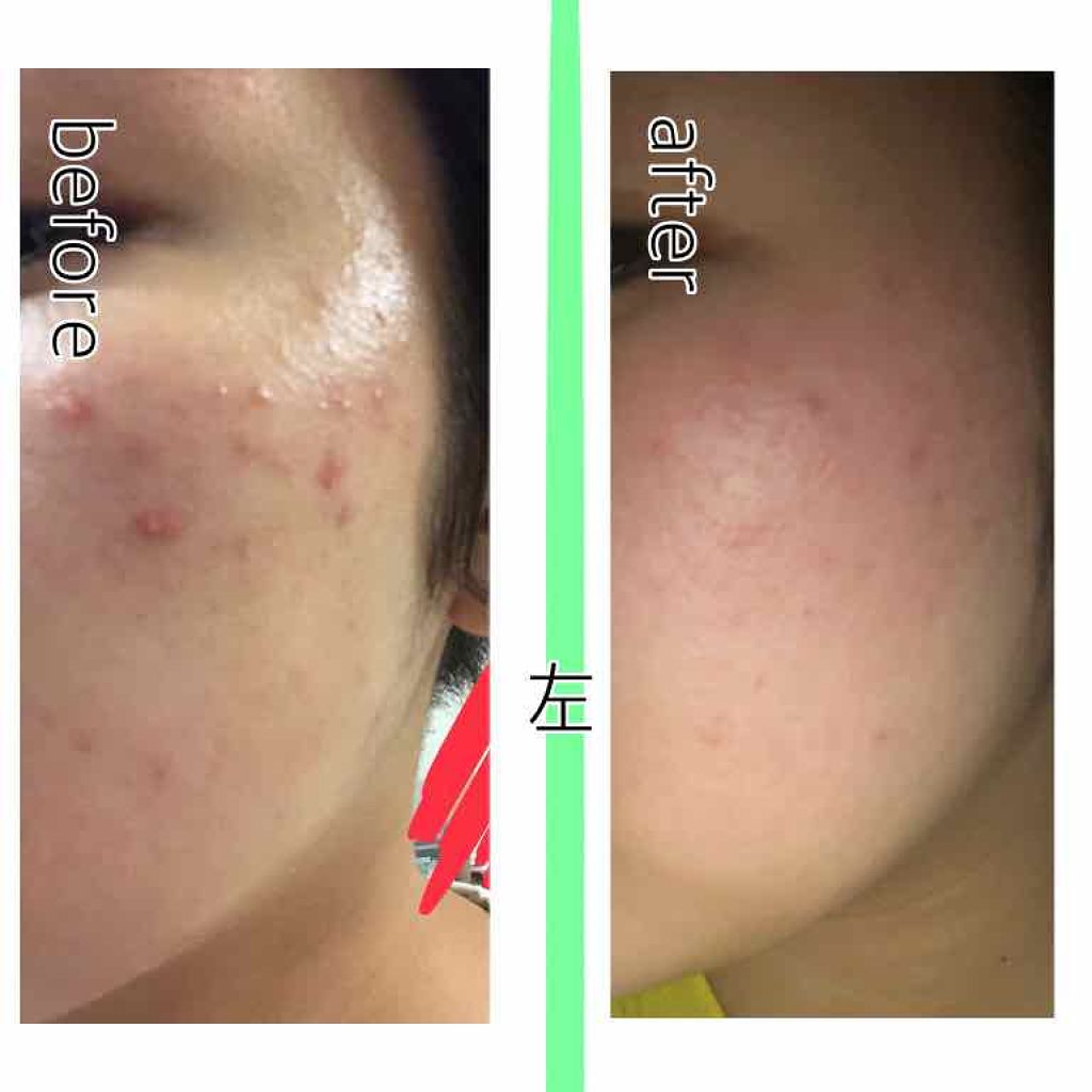 リヒト on LIPS 「投稿するかわからんかったけど写真撮っといてよかった。やっぱ皮膚..」(2枚目)