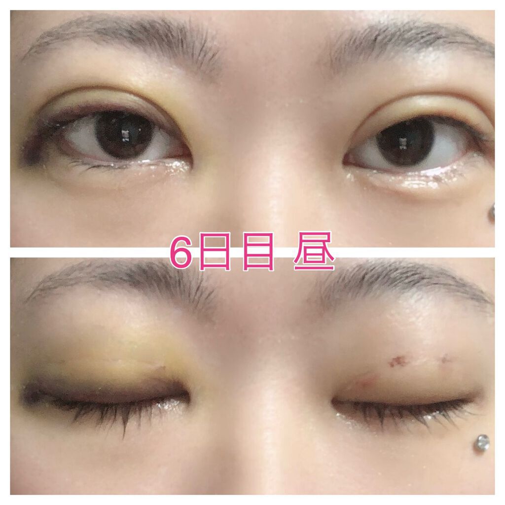 みぃ♔相互フォロー100% on LIPS 「※目の写真注意おはようございます🐣早くも7日が経過しました…4..」(3枚目)