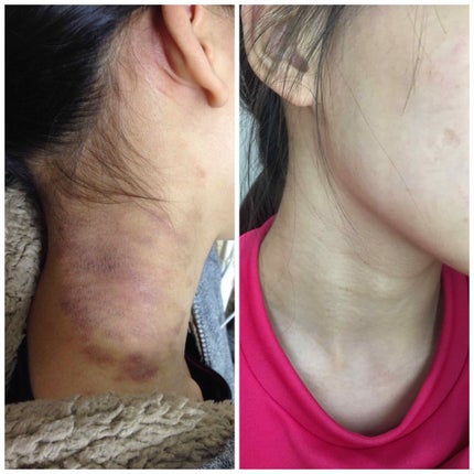 じゃりちゃん on LIPS 「ビスケラ(ビスダームクリーム)こちらは皮膚科で処方された塗り薬..」(2枚目)