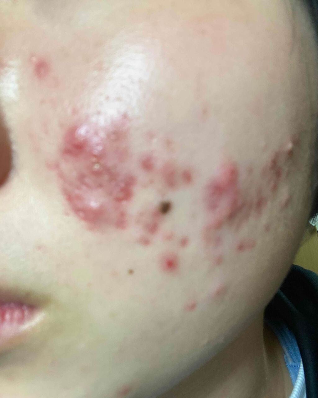 のの on LIPS 「約2ヶ月が経ちました。全く良くならないです、誰かニキビが無くな..」(1枚目)