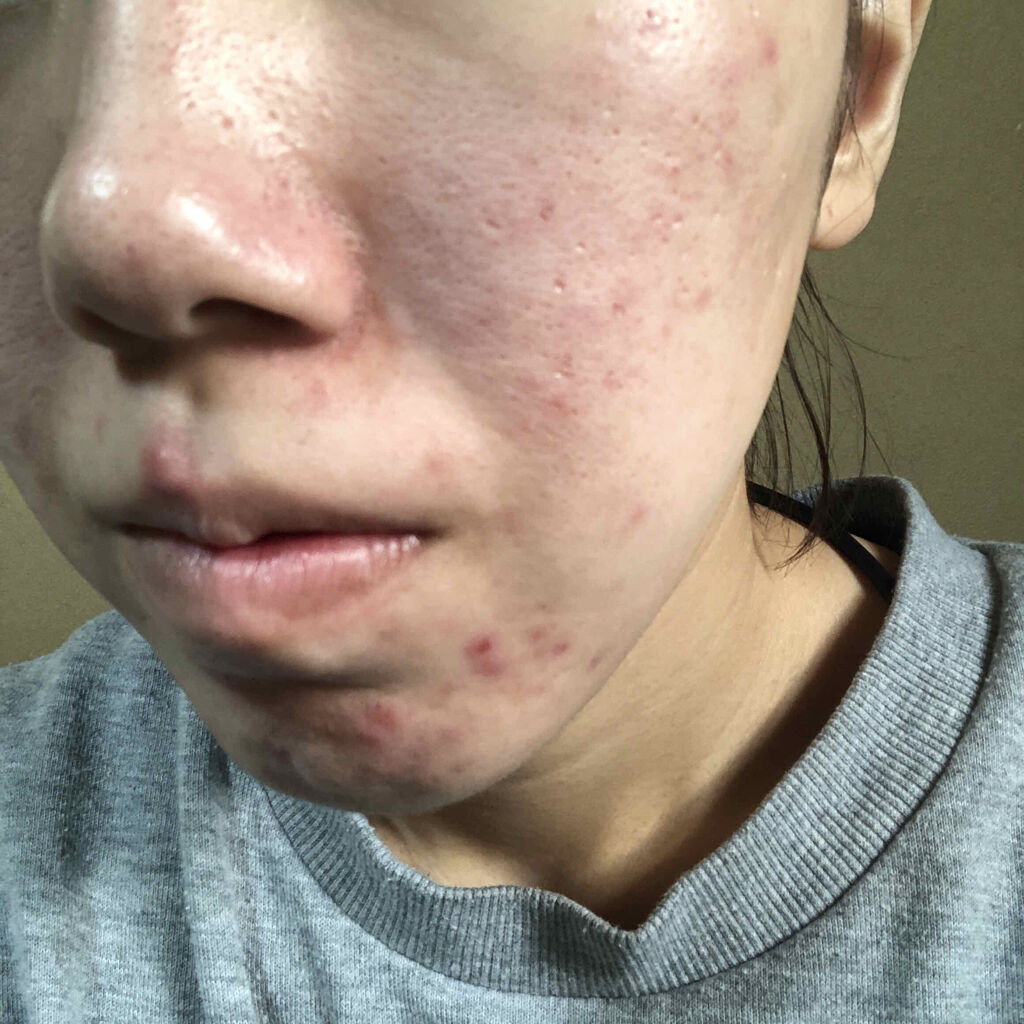 オロナインＨ軟膏 (医薬品)/オロナイン/その他を使ったクチコミ（3枚目）