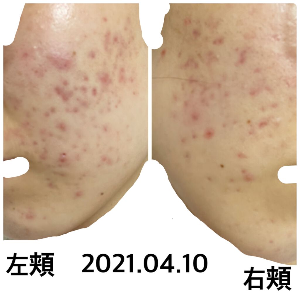 トーン ブースター セラム/to/one/ブースター・導入液を使ったクチコミ(1枚目)