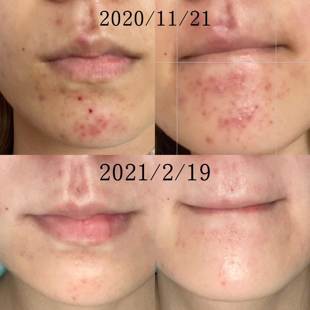 ロゼット洗顔パスタ アクネクリア/ロゼット/洗顔フォームを使ったクチコミ（2枚目）