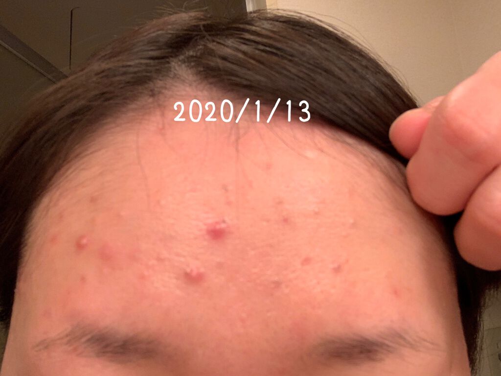 まめ on LIPS 「2020.1〜2020.11までの肌事情。25歳を迎えてからニ..」(1枚目)