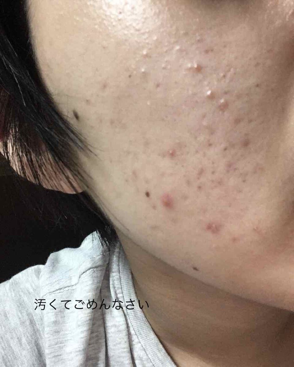 薬用 しみ 集中対策 美容液/メラノCC/美容液を使ったクチコミ（1枚目）