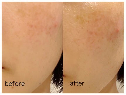 バイオームビタCダークスポットセラム/UIQ/美容液を使ったクチコミ(7枚目)