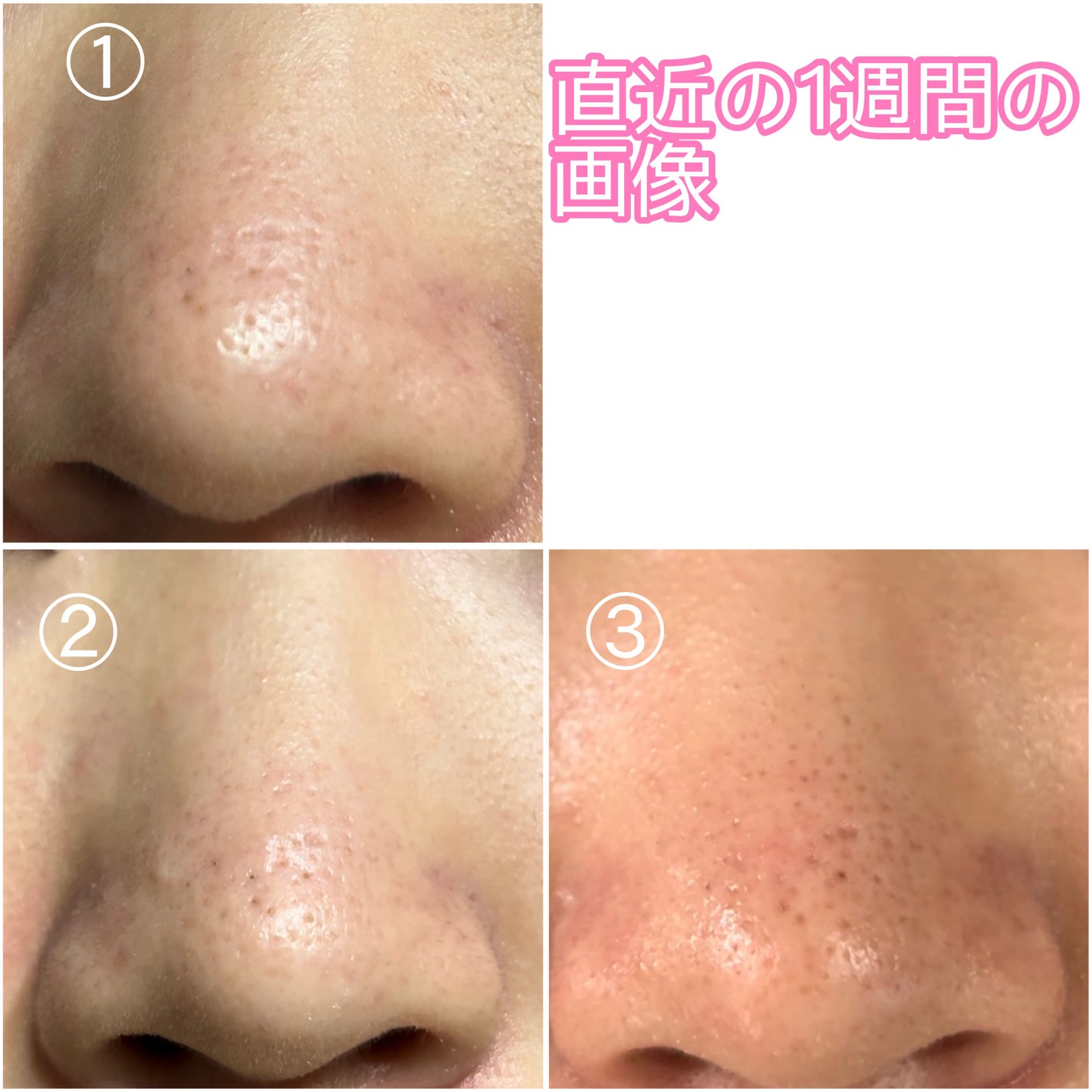 イチジク毛穴アンプル/Veganifect/美容液を使ったクチコミ(7枚目)