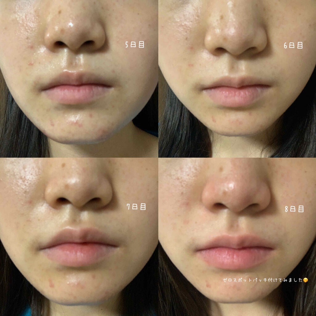 ð°ð· on LIPS ããããæ²æ»
ã®ãã30æ¥éããã¿ãã³Cãšãã¿ãã³Bã飲ã¿ç¶ããæ°Ž..ãïŒ3æç®ïŒ