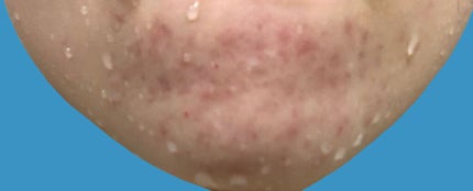 ダラシンTゲル 1% (医薬品)/佐藤製薬/その他を使ったクチコミ(3枚目)