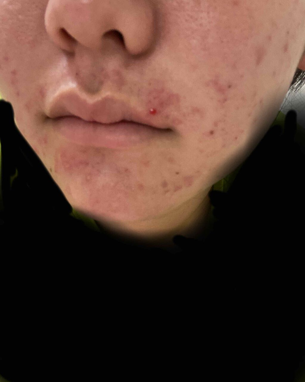 みみみ on LIPS 「助けてください。前回、ニキビが治ってきたという投稿をしたのです..」(2枚目)