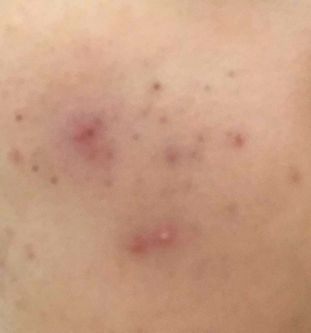 はう on LIPS 「(メラノc使用結果途中報告)こんばんははうです先日、メラノcを..」(2枚目)