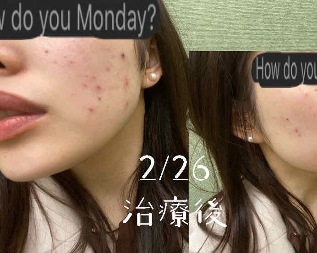 ゆんん on LIPS 「🙋♀️大人ニキビ⭐️現象12月下旬から1月中旬小さいニキビが..」(3枚目)