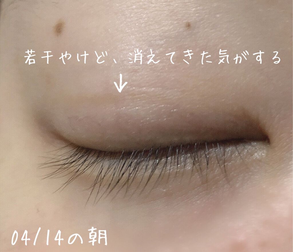 ダブルラインエキスパート Kateの口コミ 色素沈着しました 色素沈着が無くなるまで 経過写真を載っけていこうと思います By Luna 混合肌 代前半 Lips ダブルラインエキスパート Kateの口コミ 色素沈着しました 色素沈着が無くなるまで 経過写真を載っけていこうと思います By Luna 混合肌 代前半 Lips