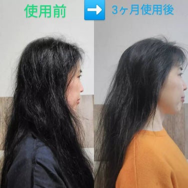 FUSARI 薬用育毛剤のクチコミ「このbefore&after写真　見て驚きました👀‼️
おでこ・頭頂部・後頭部…全体に髪がフサ.....」（3枚目）