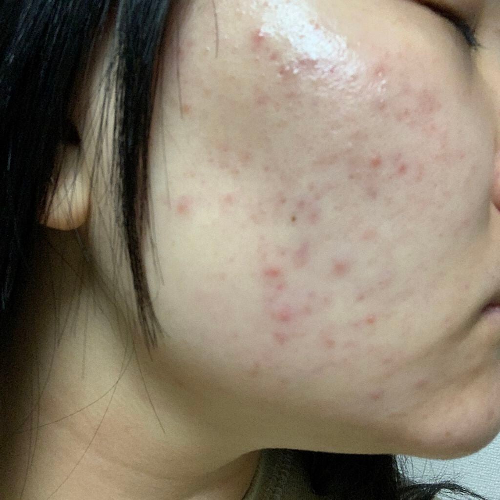 ティーツリーケア ソリューション エッセンシャルマスクEX/MEDIHEAL/シートマスク・パックを使ったクチコミ(3枚目)