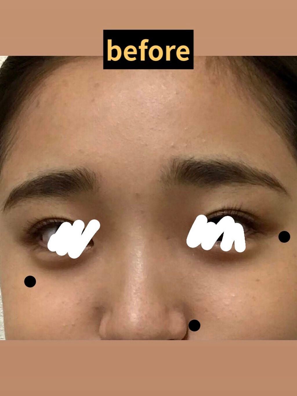 さとさくら on LIPS 「【ニキビ治療『べピオゲル』使用レポ】久々の投稿です。年明け前く..」(2枚目)