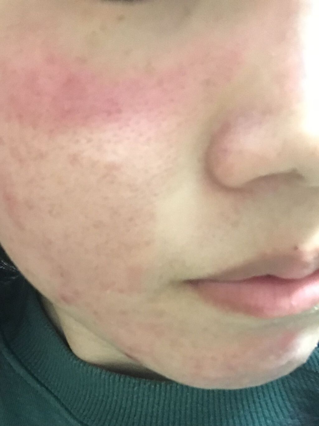 エピデュオゲル/マルホ株式会社/その他を使ったクチコミ（1枚目）