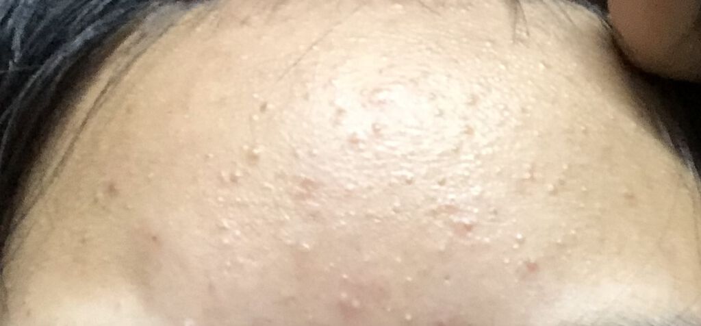 ロゼット洗顔パスタ アクネクリア/ロゼット/洗顔フォームを使ったクチコミ（3枚目）