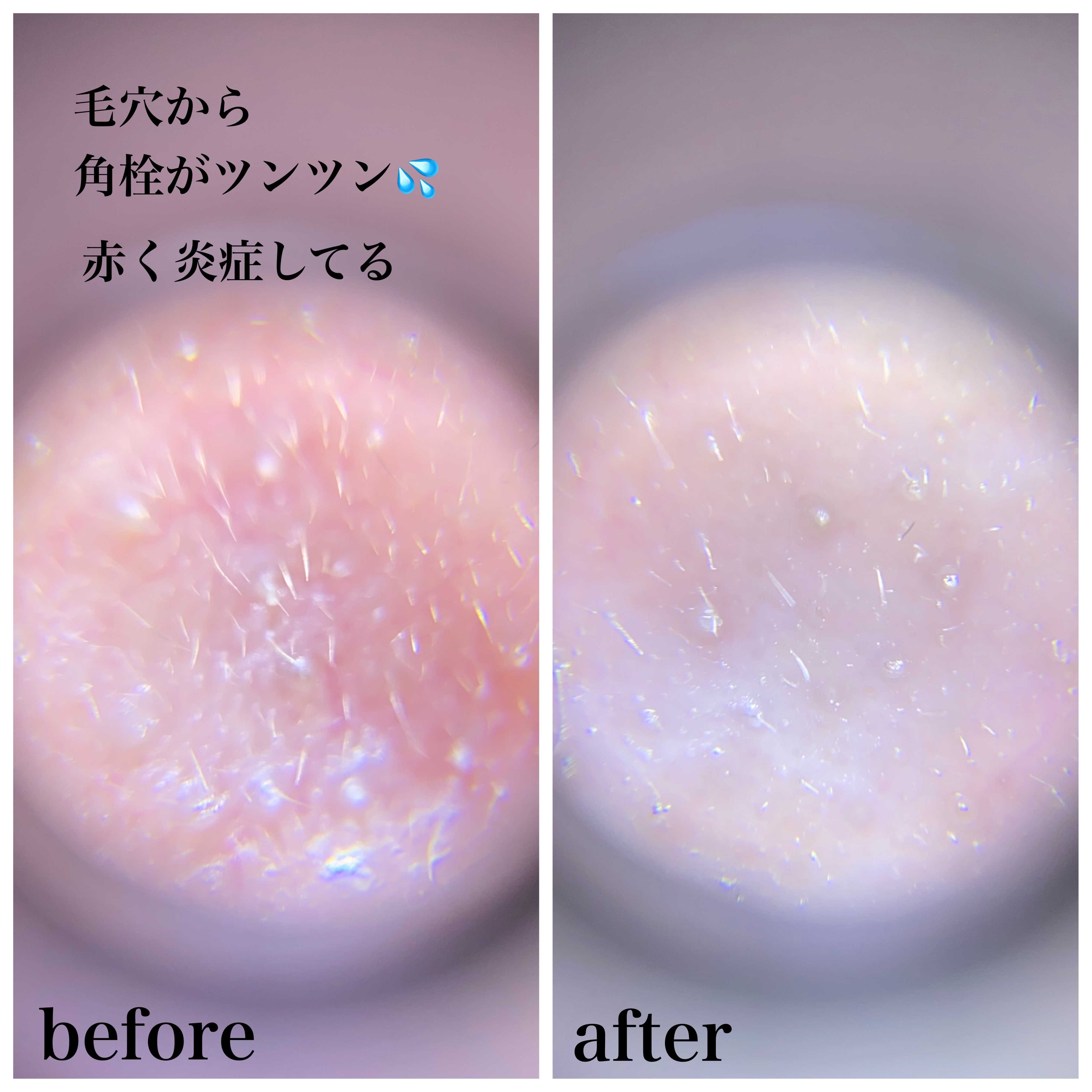 リードルショット300/VT/美容液を使ったクチコミ（2枚目）