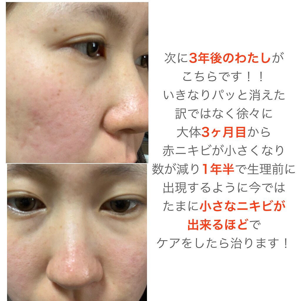 みん on LIPS 「みなさんこんにちは!今回はニキビに悩んでいた私が治った理由につ..」(3枚目)