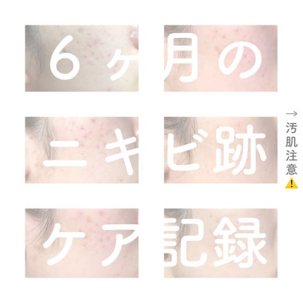 Glycolic Acid 7% Toning Solution/The Ordinary/ブースター・導入液を使ったクチコミ(1枚目)