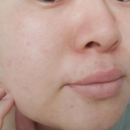 VC ホワイトピールセラム/SKIO/ブースター・導入液を使ったクチコミ(5枚目)