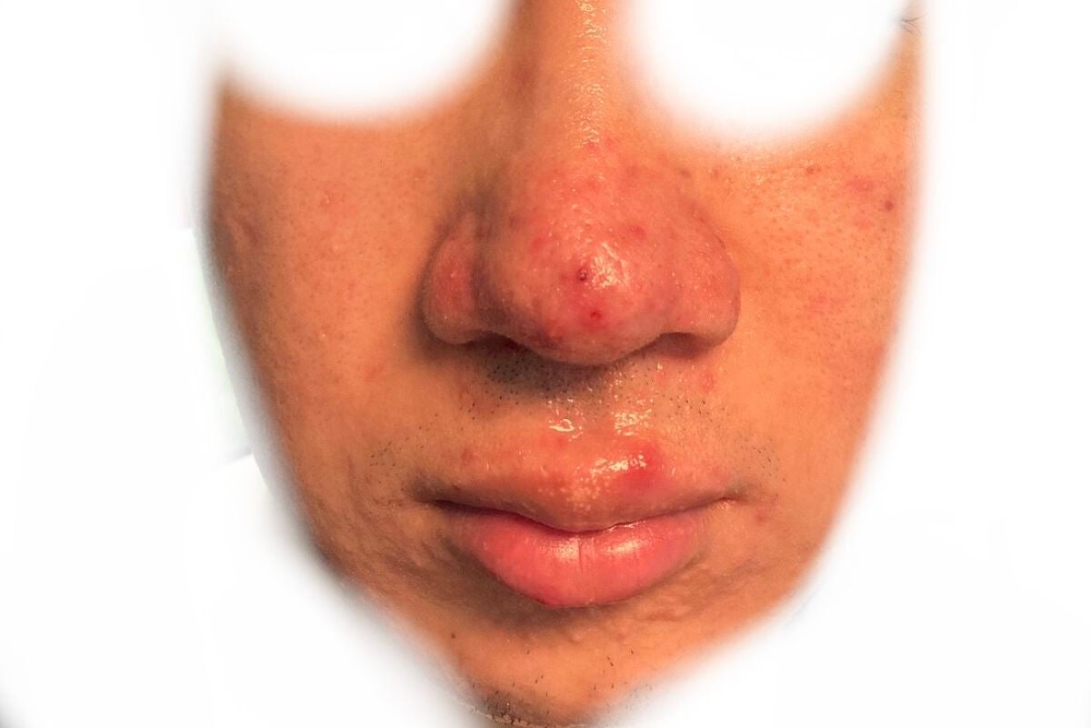 (フォロバ)3年後に韓国美男子 on LIPS 「CICA×HYALONフェスパック使用回数:24枚目特徴6:鼻..」(2枚目)