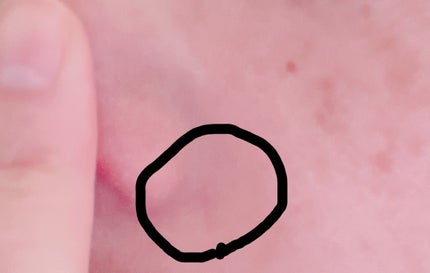 ノスカナイン スポット パッチ/FATION/にきびパッチを使ったクチコミ(3枚目)