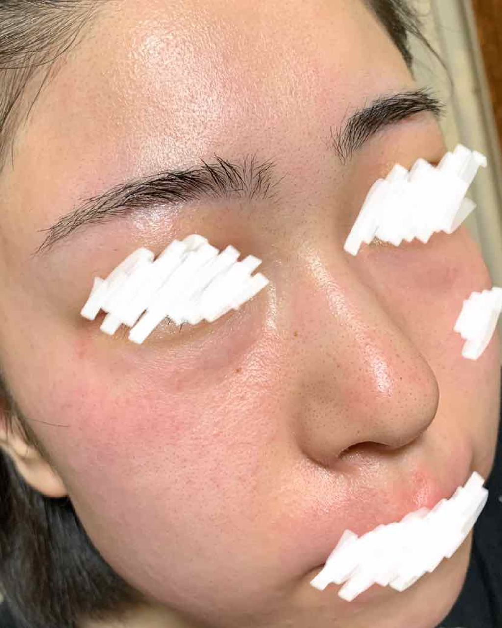 ビーソフテン ローション(医薬品)/持田製薬/その他を使ったクチコミ（2枚目）