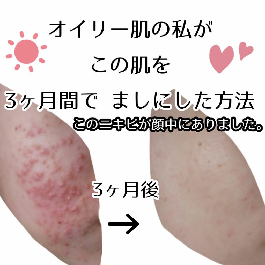 ノブ Ａ アクネソープ/NOV/洗顔石鹸を使ったクチコミ（1枚目）